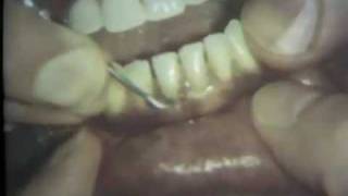 Scaling and Root Planing Part II Mandibular Teeth [upl. by Lang803]