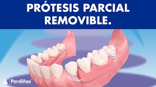 Prótesis parcial removible  ¿Cómo funcionan © [upl. by Aekahs]
