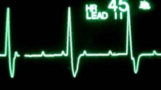 3rd Degree Atrioventricular Block [upl. by Erdnaxela]