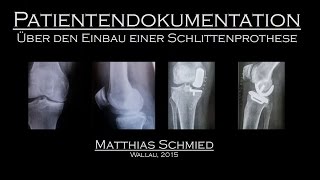 Patientendokumentation über den Einbau einer Schlittenprothese im Knie [upl. by Magee]