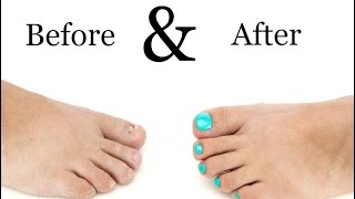 Toenail Treatment  Miracle Gelous Reconstruction [upl. by Sholley390]