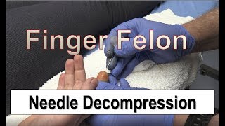 Needle Decompression of Finger Felon [upl. by Arrad334]