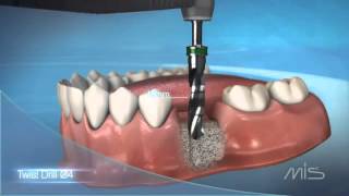 Procedimiento de colocación de implante dental MIS El Salvador [upl. by Fahland826]