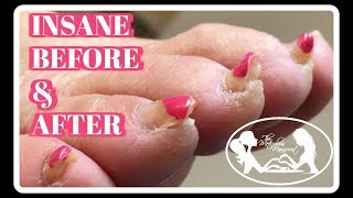 Pedicure Tutorial Elderly Thick Toenails Growing Up Transformation [upl. by Animrelliug]